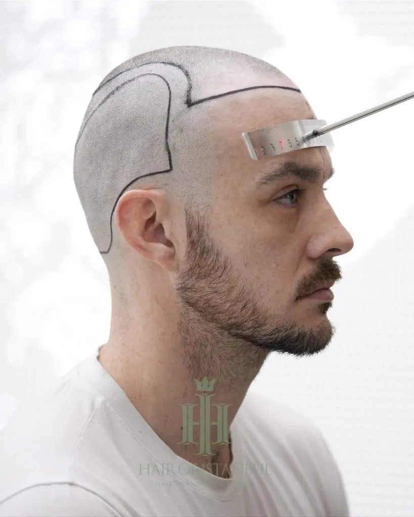 Before & After 131 Hair transplant result, 4,550 grafts, Hairline design — Hair of Istanbul