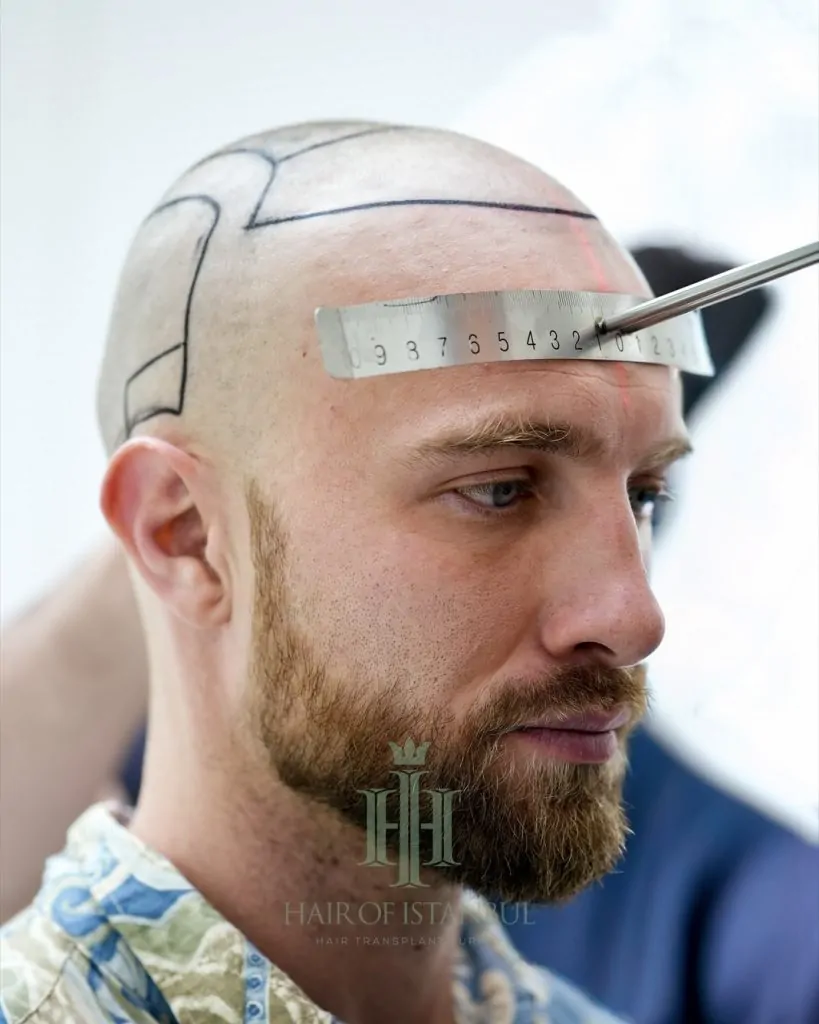 Before & After 147 Hair transplant result, 4,150 grafts, Hairline design — Hair of Istanbul