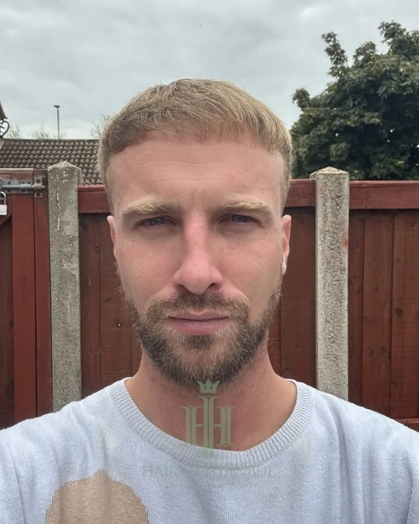Before & After 152 Hair transplant result, 4,150 grafts, Month 7 — Hair of Istanbul