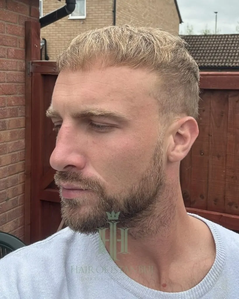Before & After 153 Hair transplant result, 4,150 grafts, Month 7 (2) — Hair of Istanbul