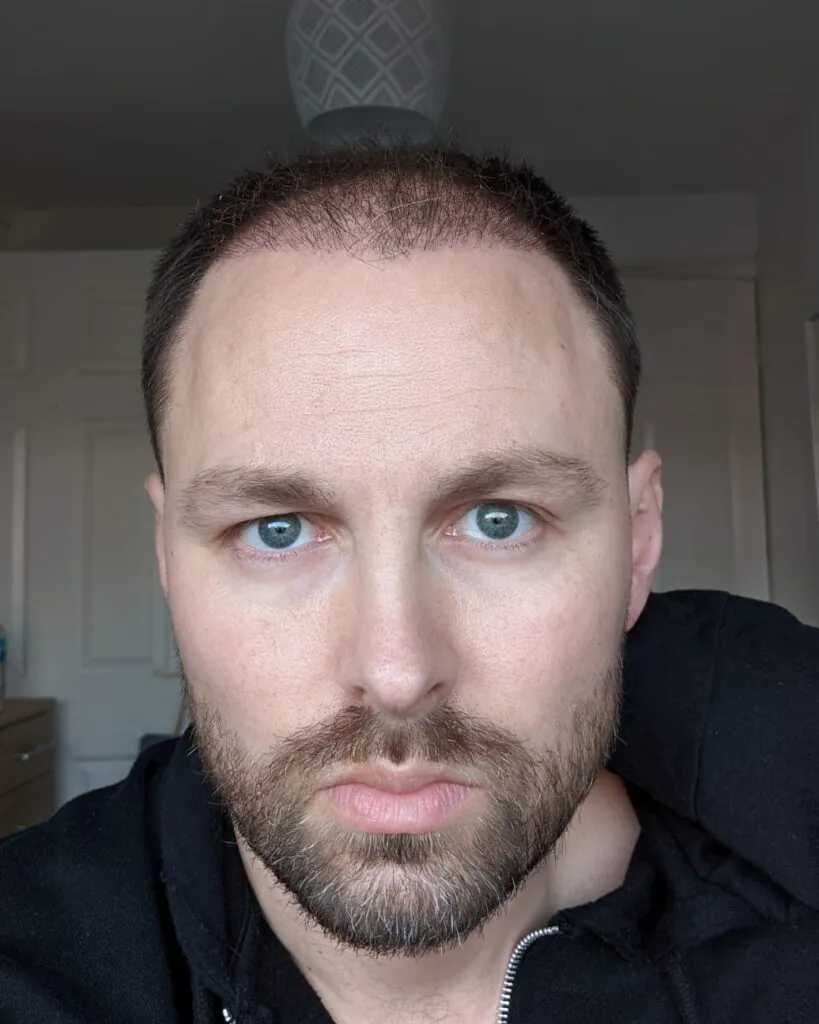 Before & After 28 Hair transplant result, 4,500 grafts, Month 3 (2) — Hair of Istanbul