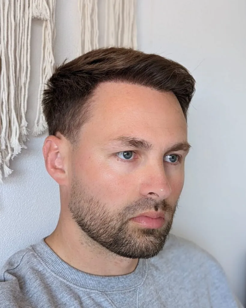 Before & After 35 Hair transplant result, 4,500 grafts, Month 12 — Hair of Istanbul