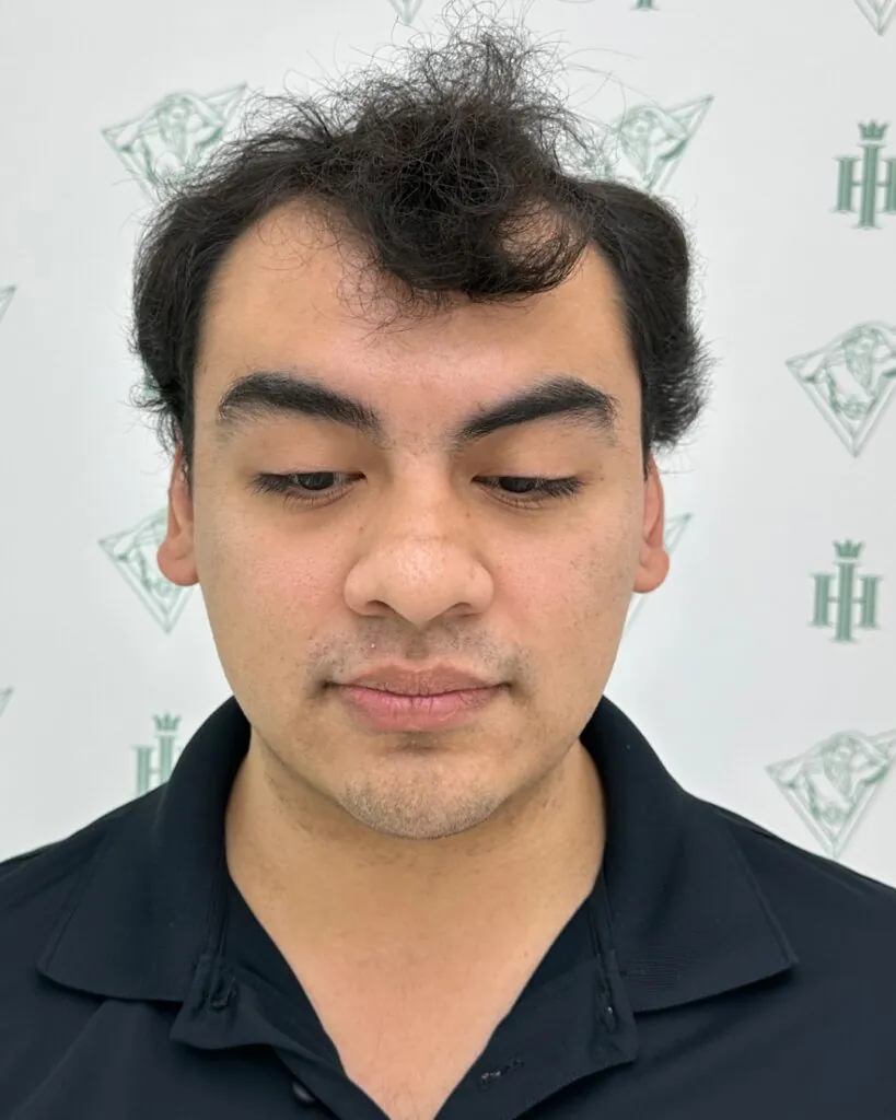 Before & After 77 Hair transplant result, 5,800 grafts, Before — Hair of Istanbul