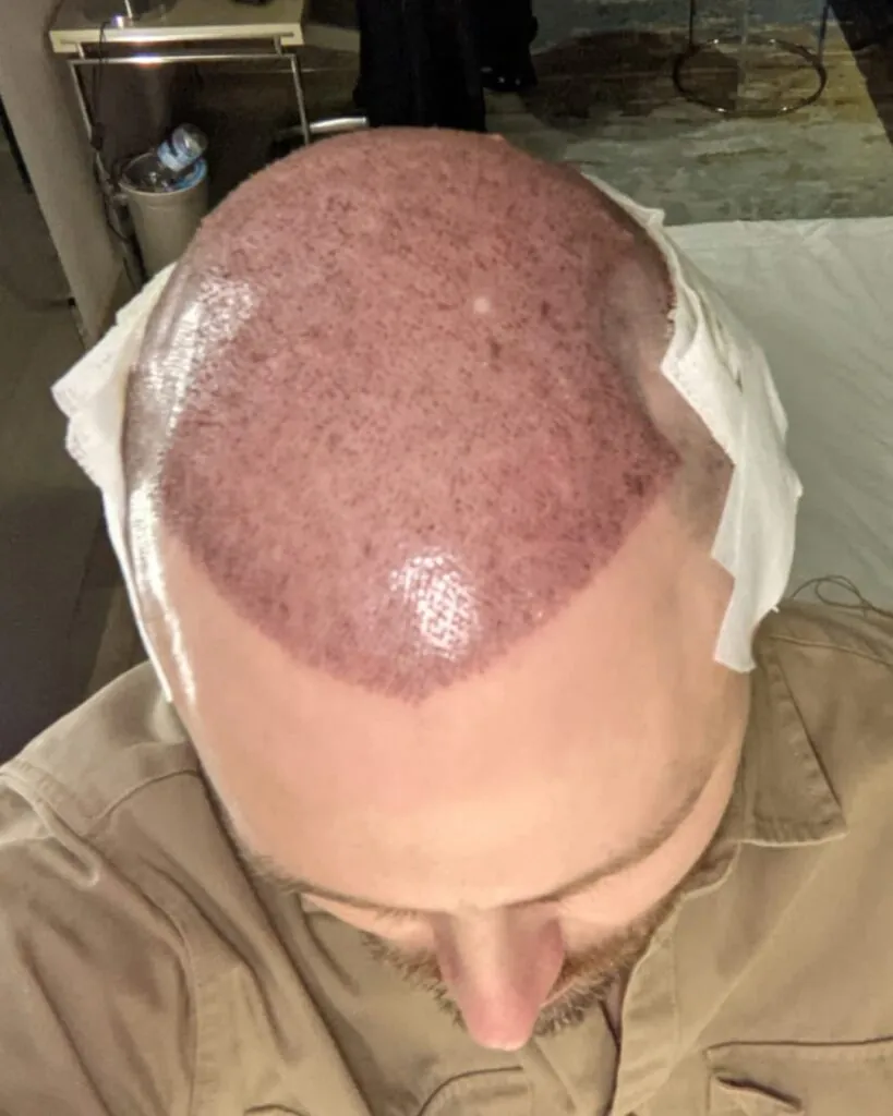 Before & After 19 Hair transplant result, 4,500 grafts, Day 1 — Hair of Istanbul