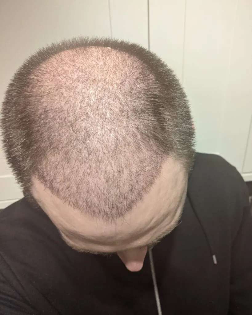 Before & After 24 Hair transplant result, 4,500 grafts, Month 1 (2) — Hair of Istanbul
