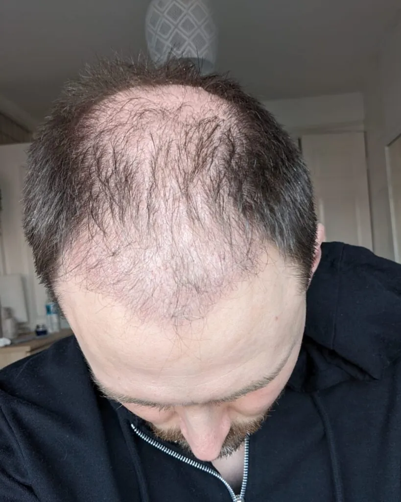 Before & After 25 Hair transplant result, 4,500 grafts, Month 1 (3) — Hair of Istanbul