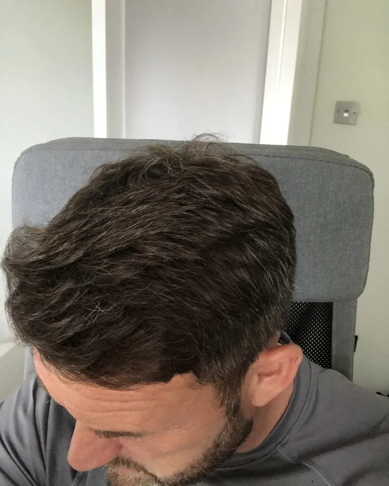 Before & After 106 Hair transplant result, 2,100 grafts, Year 6 (2) — Hair of Istanbul