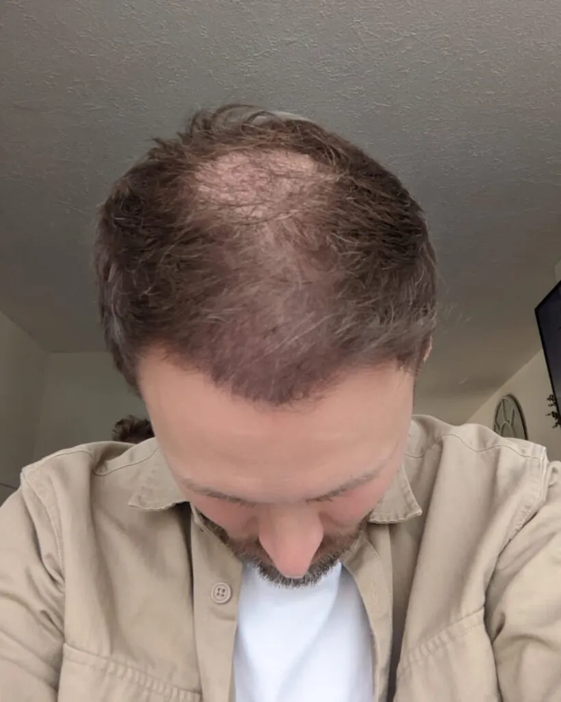 Before & After 33 Hair transplant result, 4,500 grafts, Month 5 (4) — Hair of Istanbul