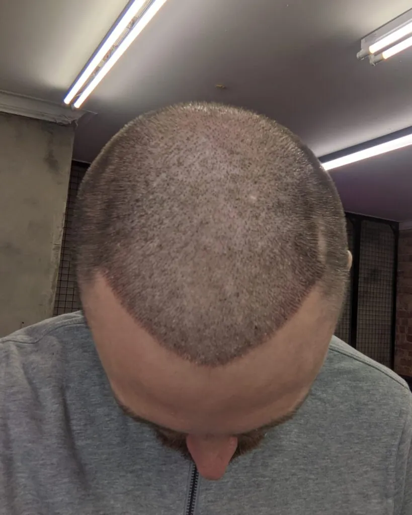 Before & After 21 Hair transplant result, 4,500 grafts, Day 10 — Hair of Istanbul