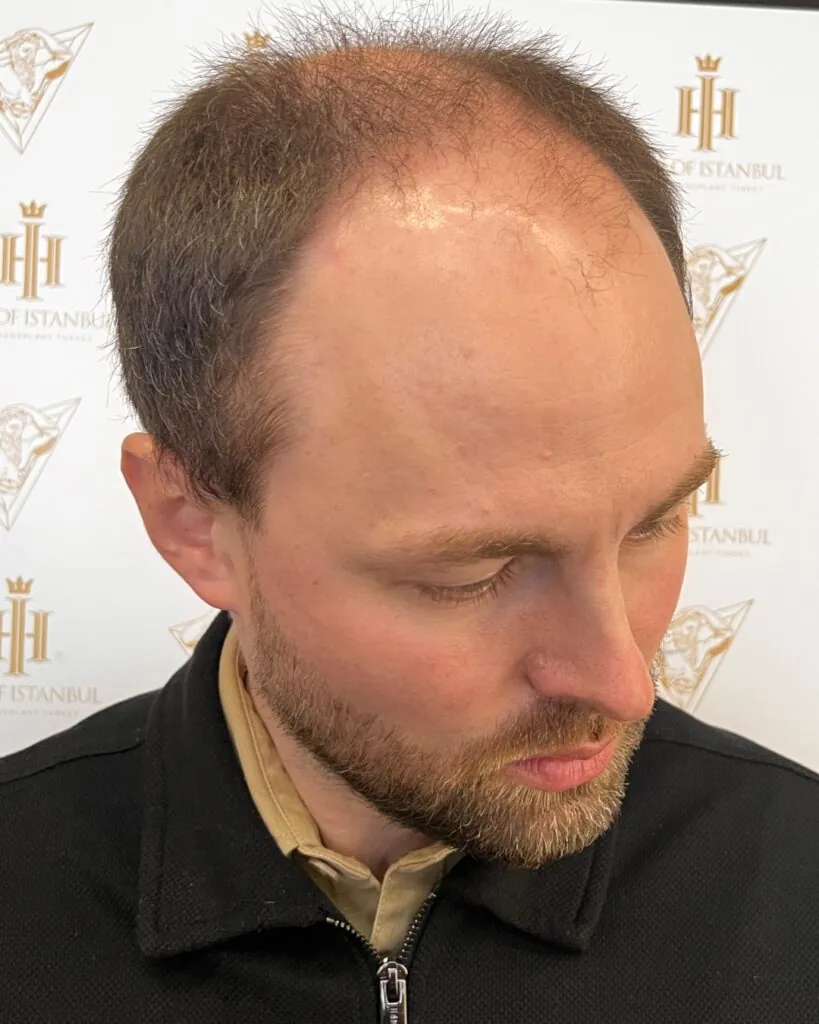 Before & After 16 Hair transplant result, 4,500 grafts, Before (3) — Hair of Istanbul