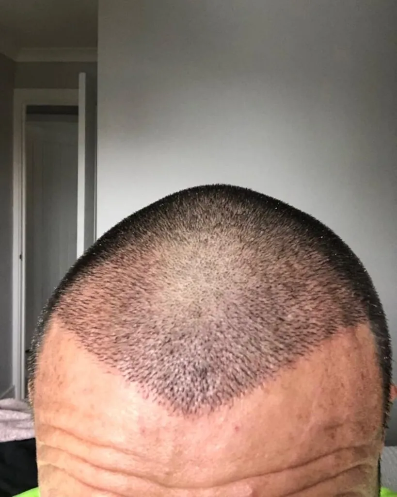 Before & After 68 Hair transplant result, 3,000 grafts, Day 10 — Hair of Istanbul
