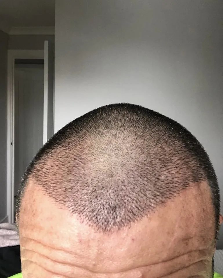 Before & After 102 Hair transplant result, 2,100 grafts, Day 10 — Hair of Istanbul