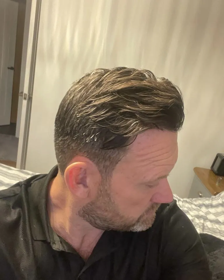 Before & After 105 Hair transplant result, 2,100 grafts, Year 6 — Hair of Istanbul