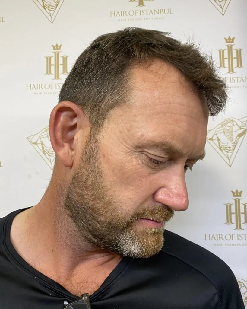 Before & After 100 Hair transplant result, 2,100 grafts, Before (2) — Hair of Istanbul