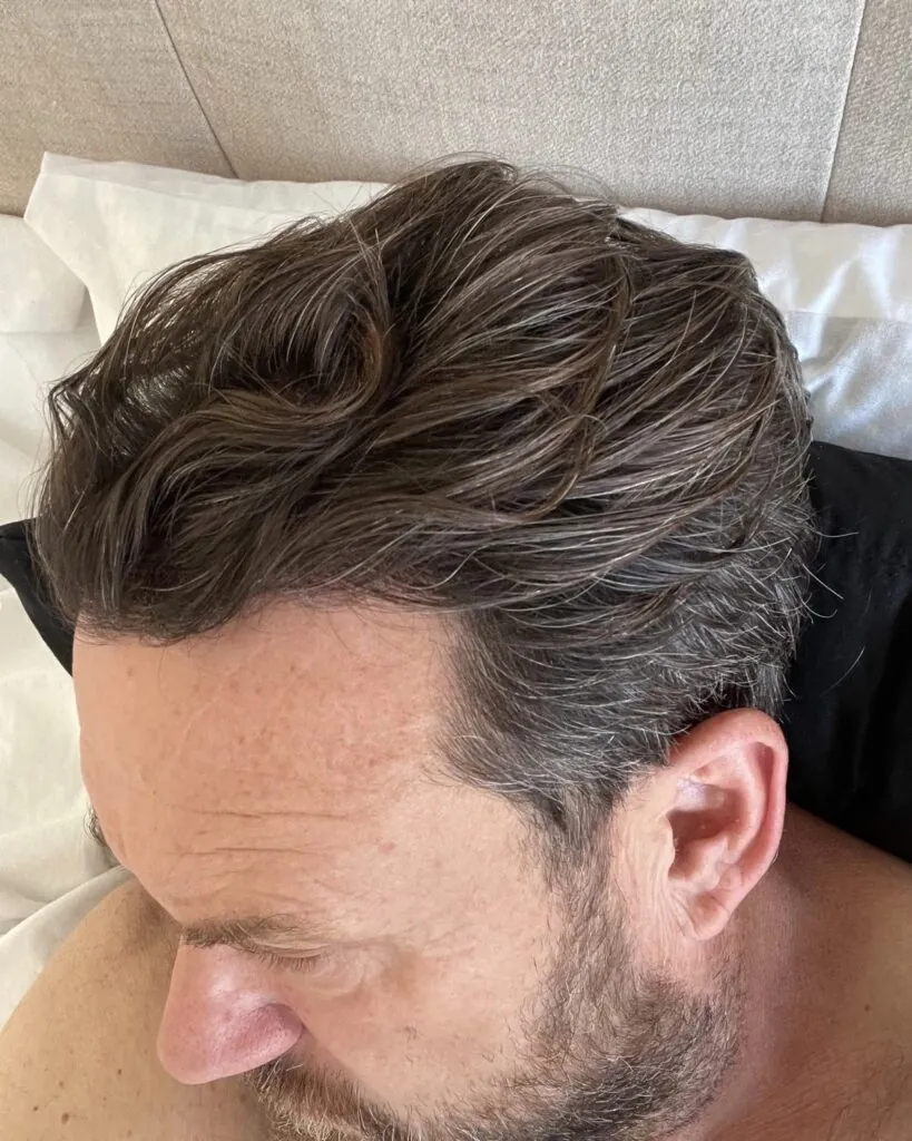 Before & After 111 Hair transplant result, 2,100 grafts, Year 6 (7) — Hair of Istanbul