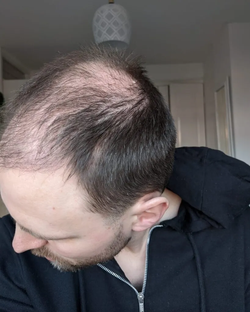 Before & After 29 Hair transplant result, 4,500 grafts, Month 3 (3) — Hair of Istanbul