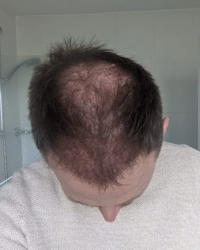 Before & After 27 Hair transplant result, 4,500 grafts, Month 3 — Hair of Istanbul