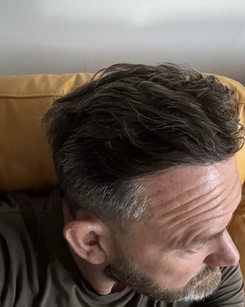 Before & After 109 Hair transplant result, 2,100 grafts, Year 6 (5) — Hair of Istanbul