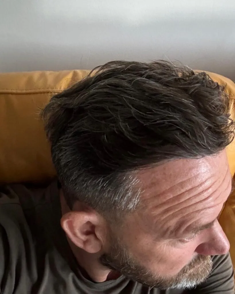Before & After 72 Hair transplant result, 3,000 grafts, Year 6 (2) — Hair of Istanbul