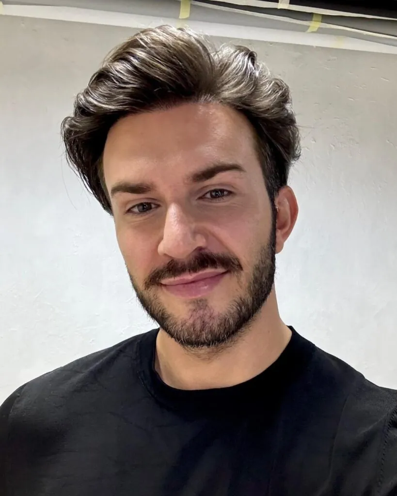 Before & After 11 Hair transplant result, 3,000 grafts, Month 12 (3) — Hair of Istanbul