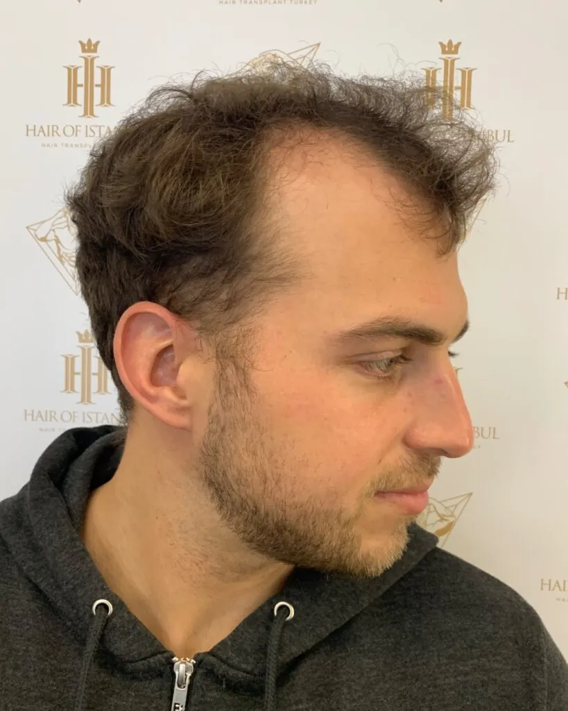 Before & After 41 Hair transplant result, 4,200 grafts, Before (3) — Hair of Istanbul