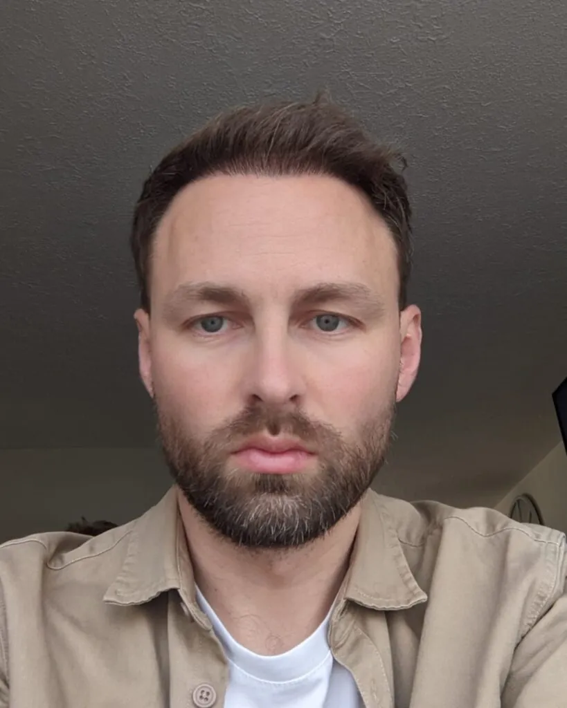 Before & After 32 Hair transplant result, 4,500 grafts, Month 5 (3) — Hair of Istanbul