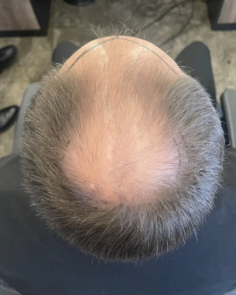 Before & After 17 Hair transplant result, 4,500 grafts, Before (4) — Hair of Istanbul