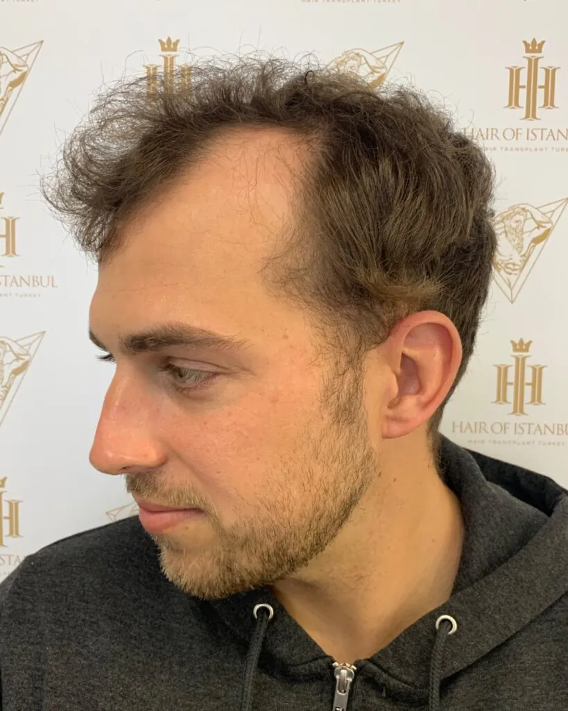 Before & After 40 Hair transplant result, 4,200 grafts, Before (2) — Hair of Istanbul