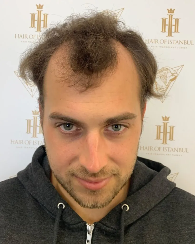Before & After 39 Hair transplant result, 4,200 grafts, Before — Hair of Istanbul