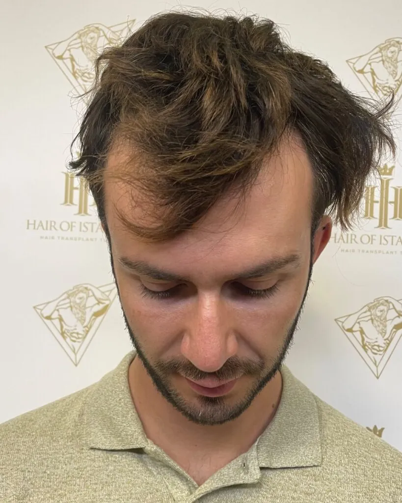 Before & After 2 Hair transplant result, 3,000 grafts, Before — Hair of Istanbul