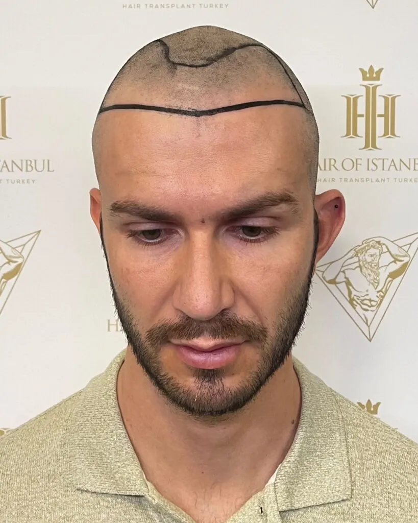 Before & After 5 Hair transplant result, 3,000 grafts, Hairline design (2) — Hair of Istanbul