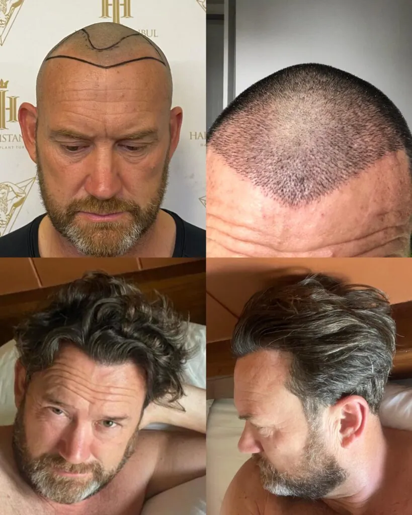 Before & After 98 Hair transplant result, 2,100 grafts, Before & After — Hair of Istanbul