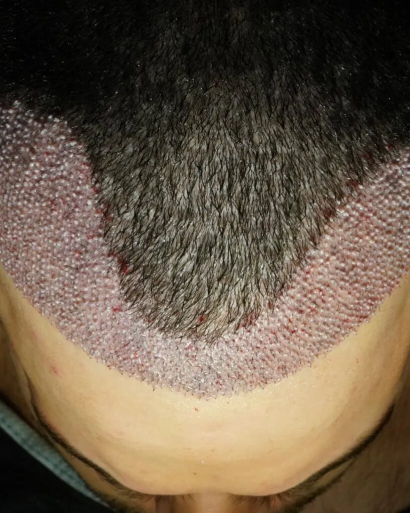 Before & After 6 Hair transplant result, 3,000 grafts, Day 1 — Hair of Istanbul