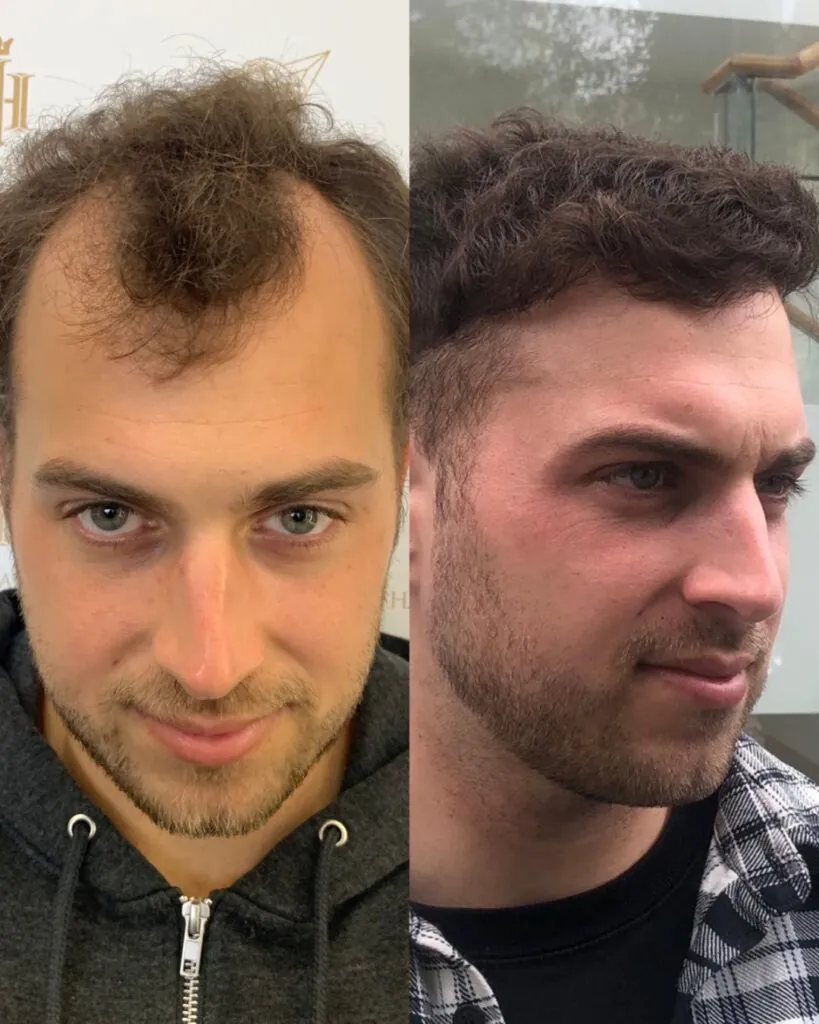 Before & After 38 Hair transplant result, 4,200 grafts, Before & After — Hair of Istanbul