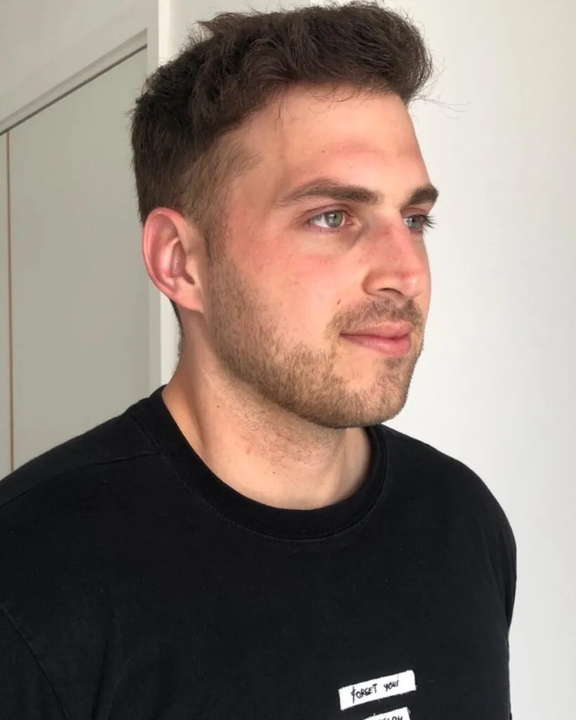 Before & After 45 Hair transplant result, 4,200 grafts, Month 12 (2) — Hair of Istanbul