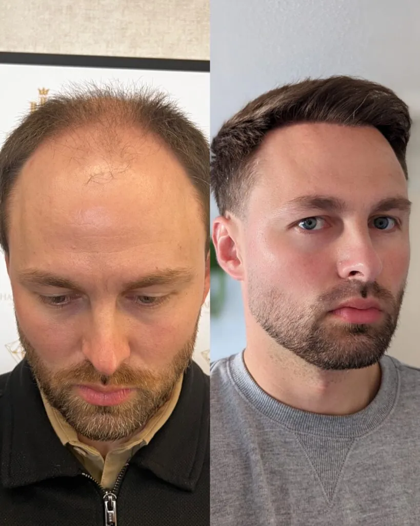 Before & After 13 Hair transplant result, 4,500 grafts, Before & After — Hair of Istanbul
