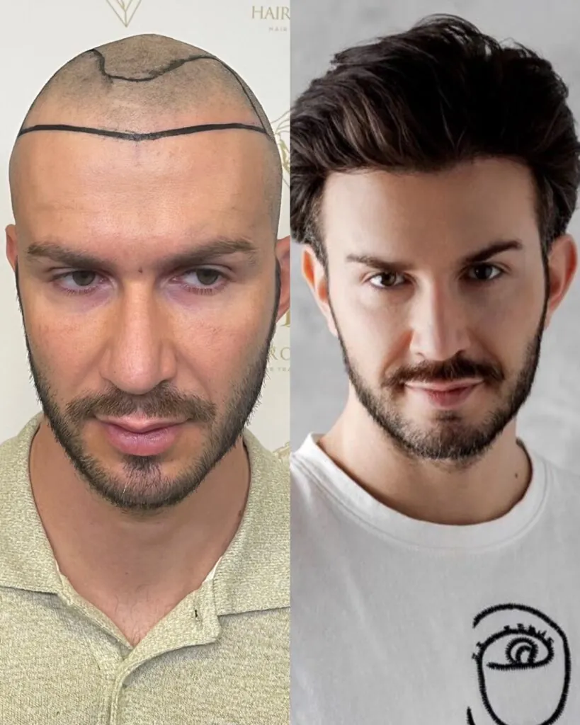 Before & After 1 Hair transplant result, 3,000 grafts, Before & After — Hair of Istanbul