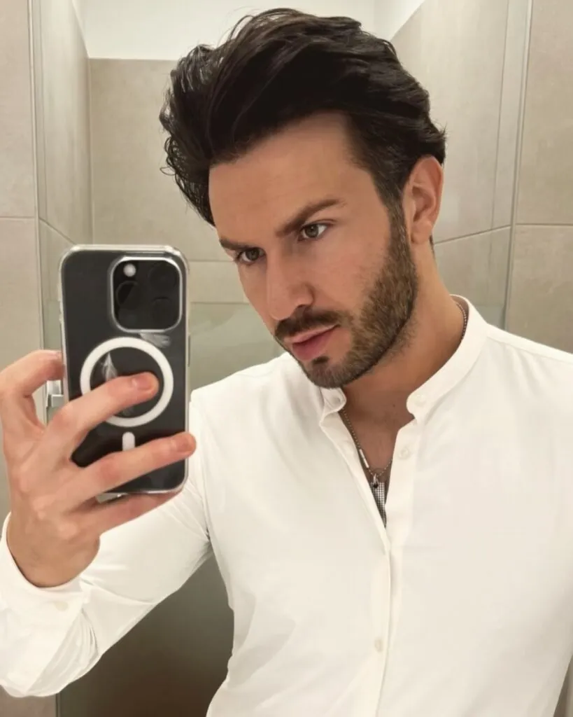 Before & After 9 Hair transplant result, 3,000 grafts, Month 12 — Hair of Istanbul