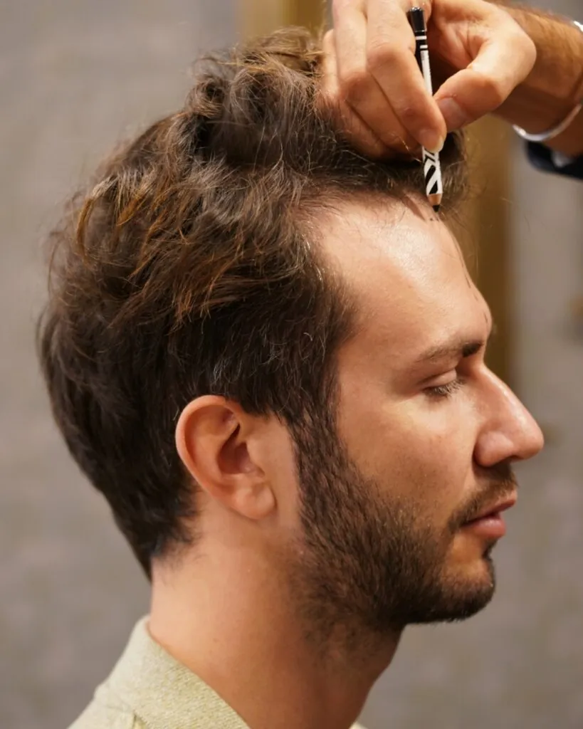 Before & After 4 Hair transplant result, 3,000 grafts, Hairline design — Hair of Istanbul