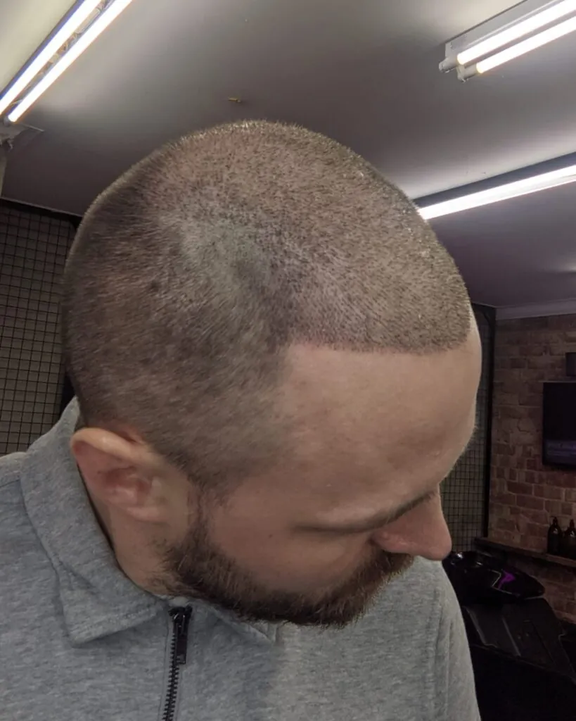 Before & After 22 Hair transplant result, 4,500 grafts, Day 10 (2) — Hair of Istanbul