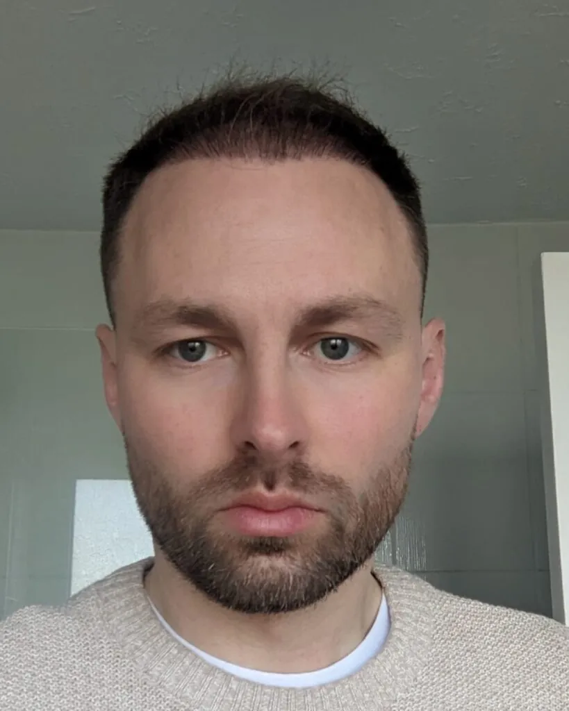 Before & After 30 Hair transplant result, 4,500 grafts, Month 5 — Hair of Istanbul
