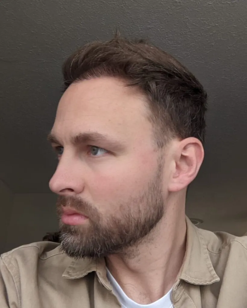 Before & After 31 Hair transplant result, 4,500 grafts, Month 5 (2) — Hair of Istanbul
