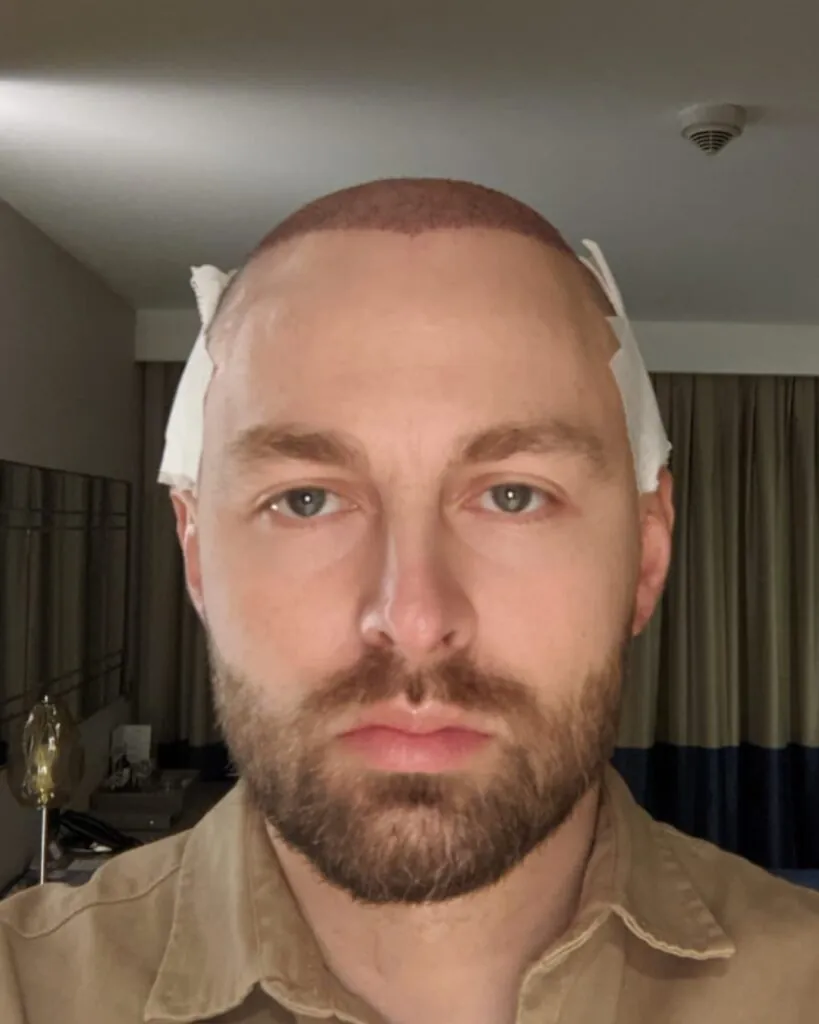Before & After 20 Hair transplant result, 4,500 grafts, Day 1 (2) — Hair of Istanbul