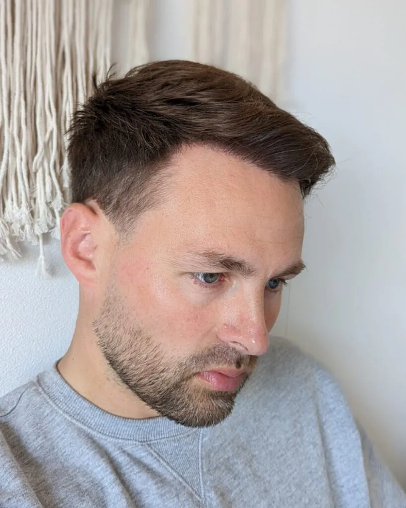 Before & After 36 Hair transplant result, 4,500 grafts, Month 12 (2) — Hair of Istanbul