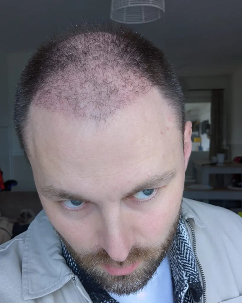 Before & After 23 Hair transplant result, 4,500 grafts, Month 1 — Hair of Istanbul