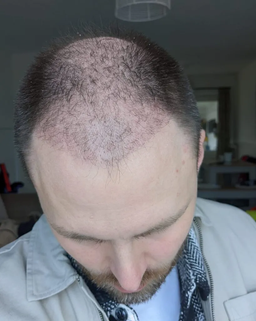 Before & After 26 Hair transplant result, 4,500 grafts, Month 1 (4) — Hair of Istanbul