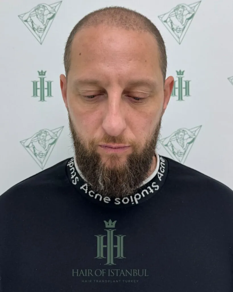 Before & After 88 Hair transplant result, 4,550 grafts, Before — Hair of Istanbul