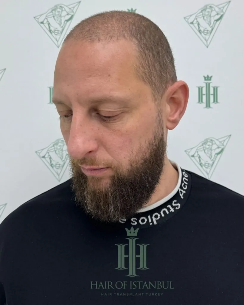 Before & After 89 Hair transplant result, 4,550 grafts, Before (2) — Hair of Istanbul