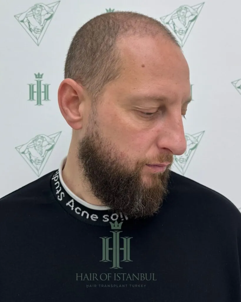 Before & After 90 Hair transplant result, 4,550 grafts, Before (3) — Hair of Istanbul