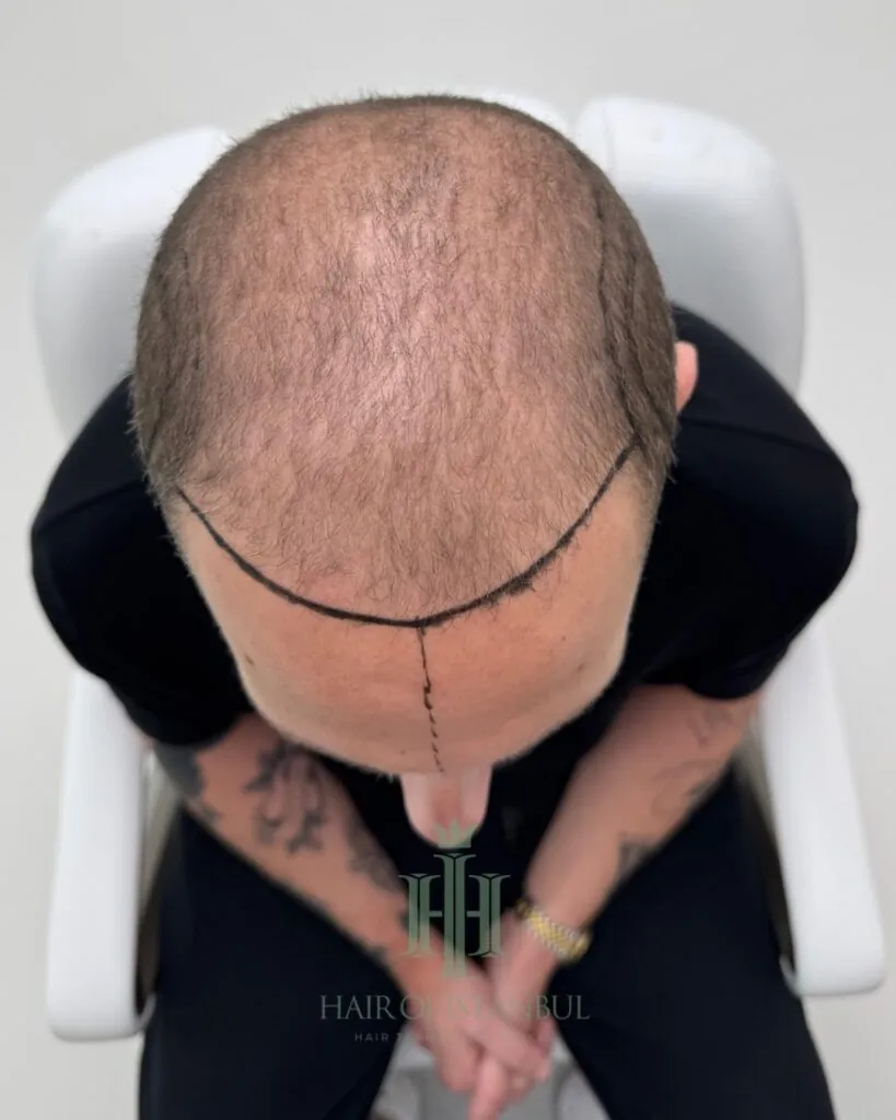 Before & After 91 Hair transplant result, 4,550 grafts, Hairline design — Hair of Istanbul